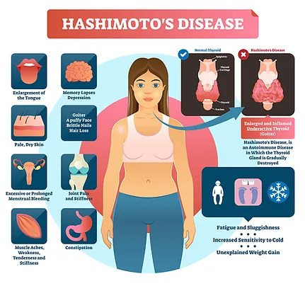 Hashimoto’s Disease thyroid disease Dr. Raphael Kellman